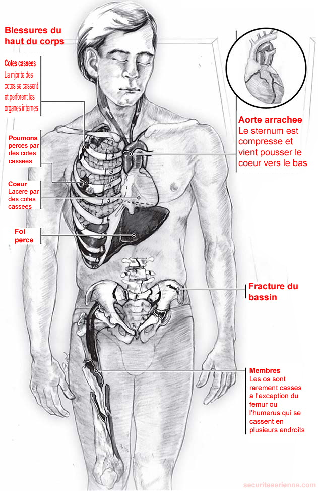 Blessures suite a saut dans l'eau